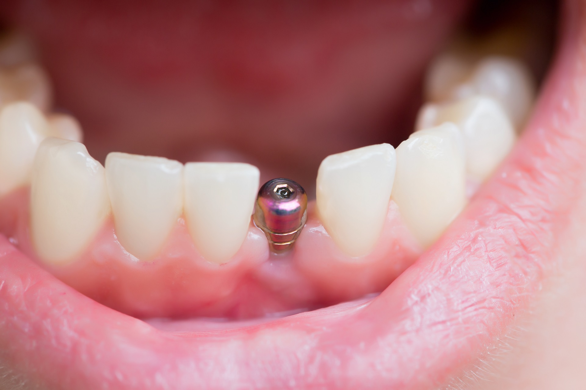 62d959d1e42c5d7368e45340_Benefits-of-Single-Tooth-Dental-Implants