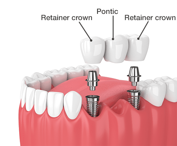 Dental-Bridge-Implants