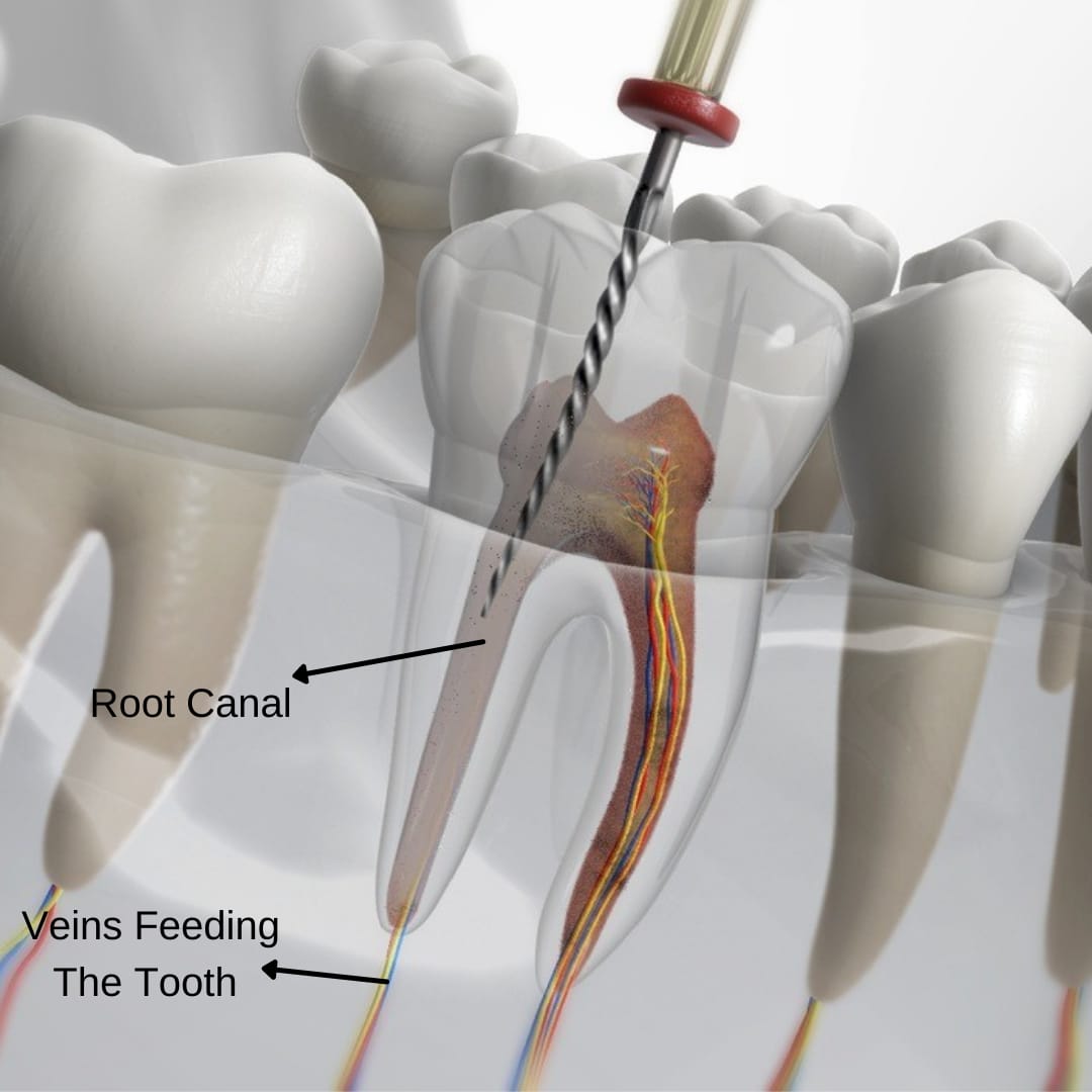 rootcanaltreatment