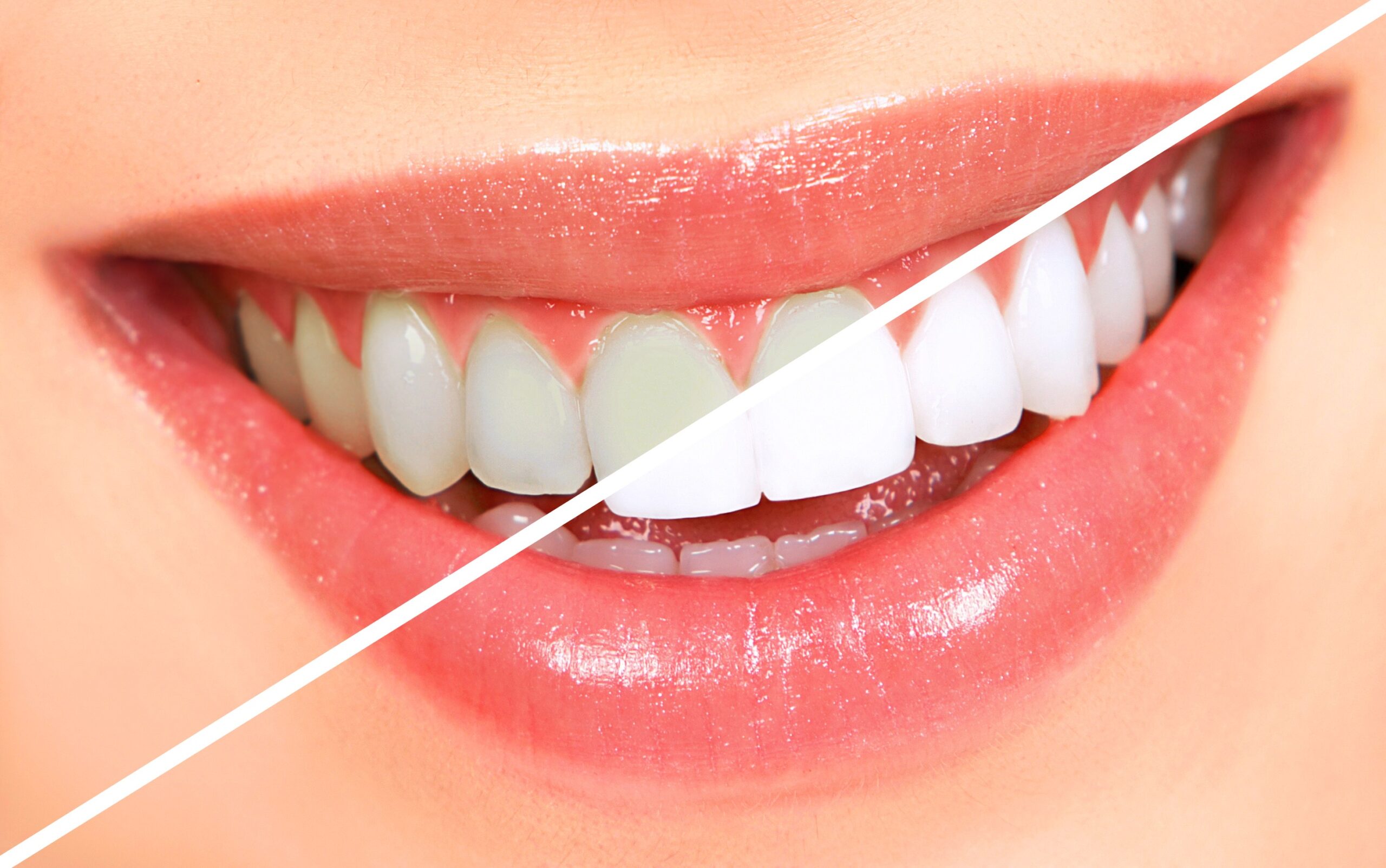 teeth-whitening-1